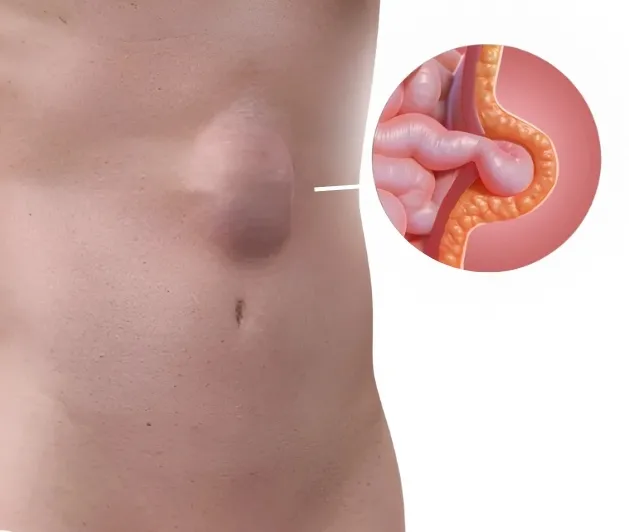 ventral hernia